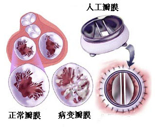 生物瓣膜是第几代产品